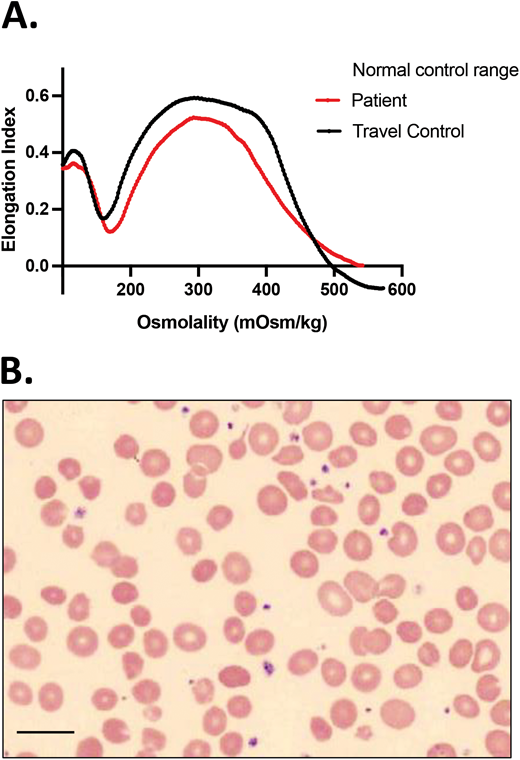 CDA-II is in the differential diagnosis for HS. A 4-year-old African American girl presented with DAT-negative, mild hemolytic anemia (Hgb, 10 g/dL) with a reticulocyte count of 2.4%, a normal ARC of 86 × 103/µL, and mild jaundice. She had a history of prolonged neonatal jaundice treated with phototherapy and no transfusion requirement. Ektacytometry showed a curve that resembled HS, and a blood smear showed spherocytes, marked poikilocytosis, and no polychromasia. Inadequate reticulocytosis and a ferritin of 80 ng/mL, at a generous level for her age with no concurrent inflammation, triggered further evaluation with sequencing of an HHA gene panel that revealed 2 SEC23B mutations, c.40C>T (p.R14W) and c.367-3A>G. Follow-up targeted sequencing of her parents confirmed that these 2 variants were in trans, causing CDA-II. Scale bar = 14 mm.