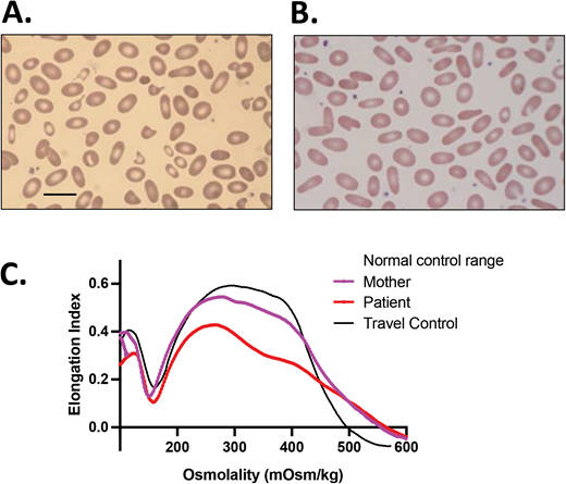 Transient infantile HPP. An African American girl presented within the first day of life after delivery at term with nonimmune hemolytic anemia and neonatal jaundice. She was treated with triple phototherapy but did not require RBC transfusion. (A) The blood smear of the patient with HPP showing marked anisocytosis and poikilocytosis with bizarre microcytes and fragmented cells along with elliptocytes (scale bar = 14 µm). (B) The blood smear of the mother, who had a normal Hgb and reticulocyte count, was notable for elliptocytes indicating HE. (C) Ektacytometry showed the trapezoid curve characteristic for HE and HPP with decreased deformability for both mother and patient. The patient's sample was sequenced by NGS on an RBC membrane gene panel, which revealed the SPTA1 HE-causing variant c.460_463insTTG (p.L155dup) as well as the SPTA1 c.6531-12C>T polymorphism known as αLELY. Targeted sequencing for these variants revealed that the mother was heterozygous for SPTA1 p.L155dup. The mother did not carry αLELY, which was presumably inherited by the father. The compound heterozygosity of an HE-causing SPTA1 mutation in trans to αLELY confirmed the diagnosis of infantile HPP. The child continued to have a mild anemia with reticulocytosis (Hgb, 10.2 g/dL with 3.8% reticulocytes) and poikilocytosis, with RDW up to 18.7% at her 2-year-old follow-up, but a CBC with reticulocyte count and blood smear at 5 years of age indicated transition to a nonhemolytic HE phenotype. RDW, RBC distribution width.