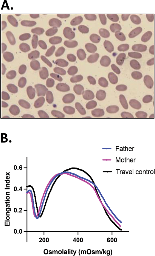 Persistent (true) HPP. A boy of Iranian descent presented with severe anemia since infancy. He remained transfusion dependent; therefore, his erythrocyte phenotype was not evaluable. (A) A blood smear of the father (practically identical with the blood smear of the mother) and (B) ektacytometry showing a trapezoid shape typical for HE for both parental samples indicated that they both had elliptocytosis. NGS on a panel of RBC membrane disorder genes revealed that the patient was homozygous for a novel missense mutation in the SPTB gene (c.6040T>G, p.F2014V), affecting the spectrin self-association site. Both parents were heterozygous for the same mutation.24