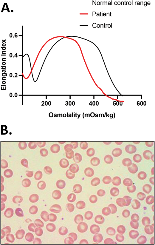 HX due to heterozygousPIEZO1 mutation. A European American girl, born at term, developed neonatal hyperbilirubinemia that prevented discharge from the nursery for 4 days while receiving treatment with phototherapy. Scleral icterus was again noted at 10 months of age, and a CBC indicated reticulocytosis but a normal Hgb. She continued to have chronic hemolysis and jaundice and had an extensive workup including negative DAT, normal Hgb electrophoresis, RBC enzyme activity testing showing normal or increased activity, osmotic fragility testing that was (probably mistakenly) reported as normal rather than as decreased, alpha and beta globin genetic testing that revealed no mutation or copy number variation, a negative PNH screen by flow cytometry, and bone marrow studies showing erythroid hyperplasia, no dyserythropoiesis, and markedly increased iron stores. (A) At 10 years of age, she had osmotic gradient ektacytometry performed that demonstrated a typical HX curve, with left shift due to decreased Omin and Ohyp (Figure 2A). The CBC at the time indicated an Hgb of 14.2 g/dL, an MCV of 96 fl, an MCH of 36.5 pg, an MCHC of 37.9 g/dL, a reticulocyte count 16.9%, and an ARC of 643 × 103/µL. (B) A blood smear was significant for polychromasia, macrocytosis, and occasional stomatocytes, target cells, and dense fragmented cells. Of note, sometimes the blood smear may be deceptively normal, with only a few target cells and no stomatocytes. A determination of the RBC intracellular cation confirmed a reduced K+ content without a corresponding increase in Na+ content. NGS for an RBC membrane disorder panel revealed 1 of the most common PIEZO1 variants (c.7367G>A, p.R2456H) causing HX. PNH, paroxysmal nocturnal hemoglobinuria.