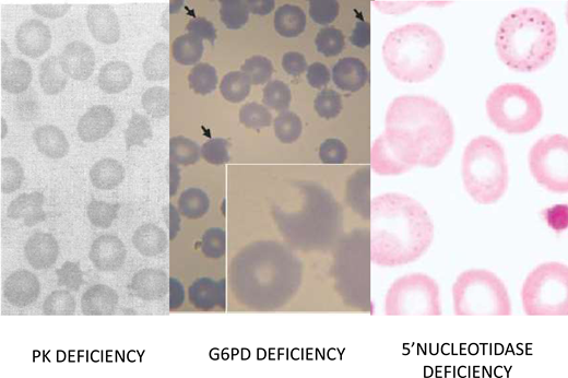 Red blood morphology in select enzymopathies.Left panel: in a patient with CNSHA due to PK deficiency, the blood smear is not diagnostic; however, the presence of “prickle red cells” should raise suspicion. From Mahendra et al.49Middle panel: “bite cells,” hemighosts and microspherocytes, characteristic of oxidative hemolysis, are seen in this smear from a child who received a dapsone-chlorproguanyl combination for the treatment of acute P. falciparum malaria. From Pamba et al.50Right panel: red blood cells with fine basophilic stippling in a patient with P5N deficiency. This enzymopathy is the most common inherited cause of basophilic stippling, which is also seen with lead poisoning (lead inhibits many enzymes, including P5N, and it can produce a phenocopy of P5N deficiency). From Rees, Duley, and Marinaki.51