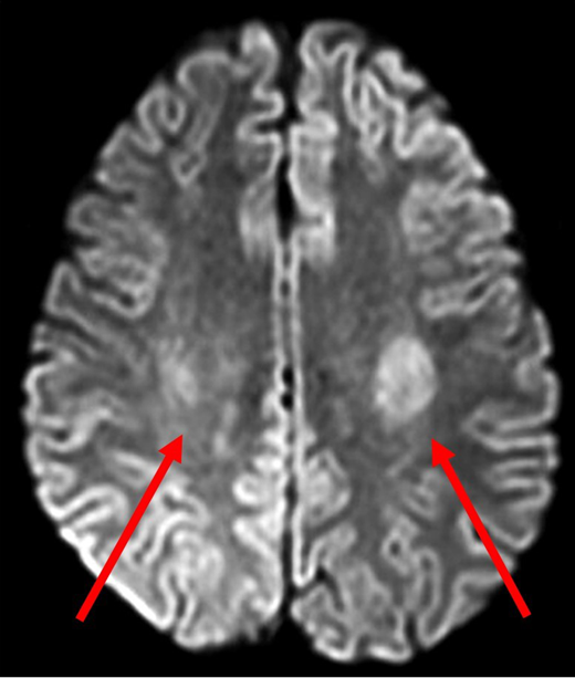 Diffusion-weighted MRI of patient 1 four hours after onset of symptoms. DWI demonstrated abnormal diffusion in bilateral centrum semiovale (red arrows), greater on the left side. These findings indicate increased diffusion of water in the affected regions suggestive of cytotoxic edema.