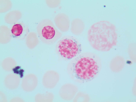 Perls' Prussian blue stain of the patient's BM smear showing RS. Classical type 3 RS are shown (according to Mufti et al57), with multiple siderotic granules in a perinuclear position surrounding the nucleus (lower-right cell) or encompassing at least one-third of the nuclear circumference (middle cell).