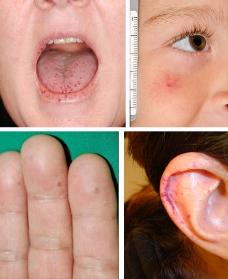 Telangiectases in HHT.