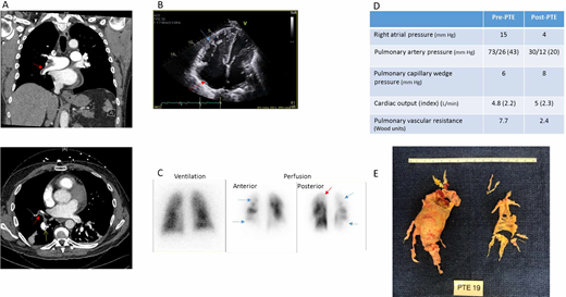 Clinical Imaging from a representative case. PTE, pulmonary thromboendarterectomy.