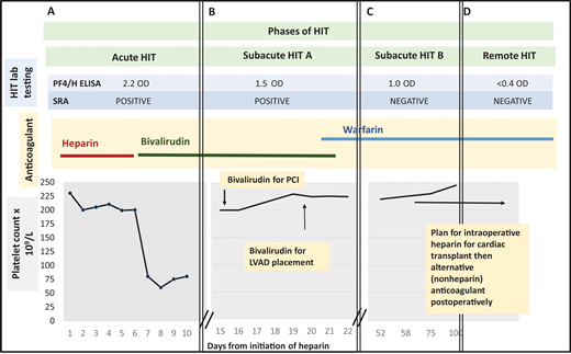 Management of a patient undergoing PCI and cardiac surgery during multiple phases of HIT. (A) Patient develops a fall in platelet count and lower extremity deep vein thrombosis 7 days after initiation of unfractionated heparin. The 4Ts score is 7. Heparin is stopped and the patient is started on bivalirudin. HIT laboratory testing reveals a positive PF4/H ELISA and positive SRA. Acute HIT is diagnosed. (B) At hospital day 15, the platelet count has recovered. The PF4/H ELISA and SRA remain positive, meeting criteria for subacute HIT A. The patient undergoes left heart catheterization with bivalirudin. At hospital day 20, he remains in subacute HIT A and requires LVAD placement that cannot be delayed. He receives bivalirudin during LVAD placement. Postprocedurally, he continues receiving bivalirudin and is bridged to warfarin for discharge to home. (C) The patient is subsequently referred to a hematology clinic for cardiac transplant evaluation. Repeat anti-PF4/H testing remains positive by ELISA (1.0 OD units) 45 days post-HIT diagnosis, but the SRA is now negative, satisfying criteria for subacute HIT B. (D) Approximately 3 months after index admission for HIT, both PF4/H ELISA and SRA are negative. The patient is listed for cardiac transplant with planned brief intraoperative heparin exposure followed by treatment with an alternative anticoagulant postoperatively. PCI, percutaneous cardiac intervention; LVAD, left ventricular assist device; PF4/H ELISA, Platelet factor-4/heparin Enzyme linked immunoassay; SRA, serotonin release assay.