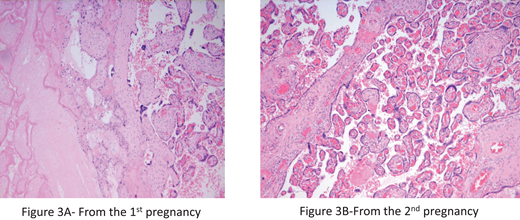 Placental histology from the clinical case. (A) Distal villous hypoplasia and infarction at 28 weeks' gestation in untreated congenital TTP. (B) Normal villi in the subsequent delivery from the same mother after treatment throughout pregnancy. ADAMTS-13 replacement was via plasma infusion.