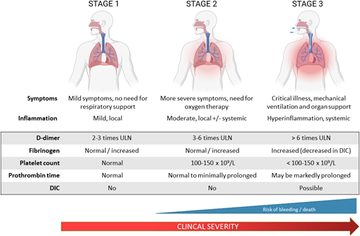 Stages of CAC. The spectrum of coagulation abnormalities in COVID-19 parallels disease severity. In stage 1, patients exhibit mild symptoms and evidence of mild localized inflammation and coagulopathy with elevations in D-dimer approximately 2 to 3 times the upper limit of normal. Stage 2 is characterized by more severe symptoms requiring supplemental oxygen with pulmonary inflammation and intravascular coagulation activation in the lungs as well as some systemic involvement. This is reflected in further D-dimer elevation to 3 to 6 times the upper limit of normal. Patients progressing to stage 3 require critical care with respiratory and other organ support and demonstrate severe systemic inflammation and coagulopathy with markedly elevated D-dimer and fibrinogen, prolonged PT, thrombocytopenia, and high incidence of thromboembolism. A proportion of these patients will develop overt DIC as a result of their COVID-19 illness or other superimposed infections.18