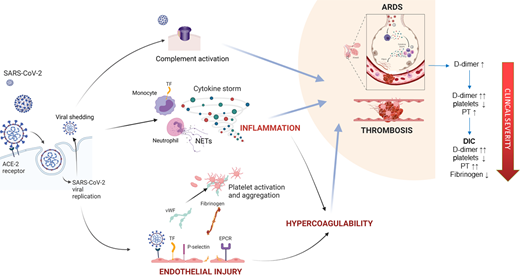 Pathogenesis of CAC. SARS-CoV-2 binds the angiotensin-converting enzyme 2 receptor on respiratory epithelium and endothelial cells. Viral replication and shedding lead to pneumocyte and endothelial cell apoptosis, triggering an inflammatory response, which in a portion of patients leads to pathogenic cytokine storm. These cytokines and endothelial injury result in procoagulant changes, including the release of VWF and FVIII and the upregulation of TF, P-selectin, and fibrinogen. Anticoagulant proteins such as endothelial protein C receptor, antithrombin, and thrombomodulin are downregulated. Fibrinolytic impairment also contributes to hypercoagulability. Neutrophil activation and the release of neutrophil extracellular traps further stimulate thrombosis, and platelets in COVID-19 may exhibit marked hyperreactivity. SARS-CoV-2 spike proteins may directly amplify complement, and contribute to vascular injury and microthrombosis. The coagulation derangements observed in COVID-19 are a direct result of microthrombosis, which is initially localized to the lungs, causing elevations in D-dimer and fibrinogen. As the disease progresses, more systemic inflammation and the activation of coagulation lead to thrombocytopenia and prolongation of clotting times. In some patients this may progress to a frank consumptive coagulopathy.