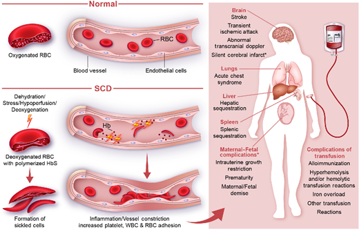 Indications for transfusion of RBCs in SCD. The pathophysiology of SCD renders transfusions useful for many complications. Consideration of the clinical scenario for an individual patient is always important, especially for some (*) indications for transfusion.