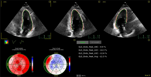 Example of borderline left ventricular systolic function (ejection fraction of 50%-55%) per 2-dimensional echocardiogram supplemented with myocardial strain measurements, which show abnormal global longitudinal strain (−12.3%) 15 years after cancer treatment. Patient was originally treated for Hodgkin lymphoma per Children's Oncology Group protocol AHOD0031 with doxorubicin, bleomycin, vincristine, etoposide, cyclophosphamide, and neck radiation.