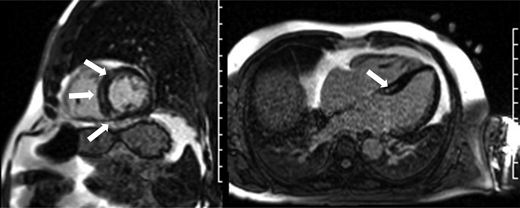 Example of cardiac magnetic resonance imaging revealing mildly reduced ejection fraction (52%; lower end of normal being 58%) with mid-myocardial delayed enhancement indicative of cardiac fibrosis (white arrows) in a long-term non-Hodgkin lymphoma survivor >30 years after doxorubicin-based chemotherapy who presented with premature ventricular contractions.