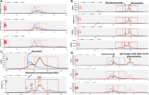 (A) MALDI-TOF results in normal serum (no monoclonal protein present). The x-axis represents mass/charge ratio. Three separate rows are presented for each heavy chain isotype. (B) MALDI-TOF results after each cycle of daratumumab in a patient with IgG kappa MM. The pathogenic clone and daratumumab have different molecular weights and are therefore easily distinguishable. Reference mass/charge ratios exist for several other moAbs used in treating myeloma that can achieve a serum concentration high enough to cause interference. (C) “Immune reconstitution” (oligoclonal) pattern seen after autologous transplant. Multiple IgG kappa and lambda clones are noted, but the initial pathogenic clone is absent. (D) A monoclonal IgG kappa protein with a glycosylated light chain in an AL amyloidosis patient treated with daratumumab. Glycosylated IgG kappas are up to 12 times more common in patients with AL amyloidosis and are present years before the diagnosis of AL amyloidosis is made.