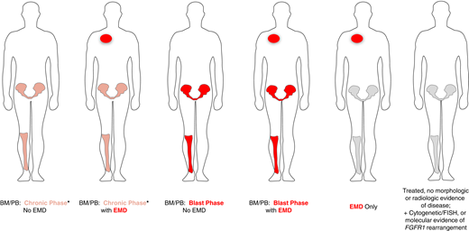 Clinical presentations of MLN with eosinophilia and tyrosine kinase gene fusions. *BM/PB can present with a concurrent chronic myeloid neoplasm as well as acute lymphoblastic leukemia/lymphoma (B- or T-cell lineage) or mixed-phenotype acute leukemia.