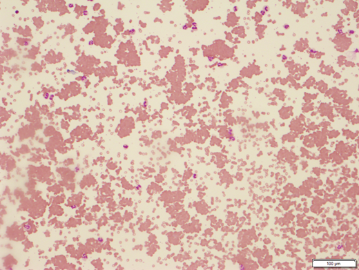 Peripheral blood smear from patient with cold agglutinin disease showing red blood cell clumping (100 × ). Image courtesy of Dr Tarek M. Elghetany.