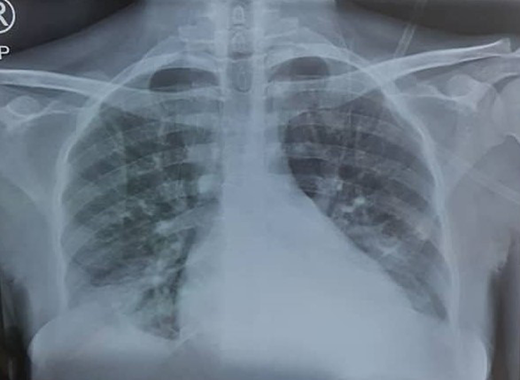 Chest radiograph (PA view) showing pulmonary infiltrates classic to ACS.