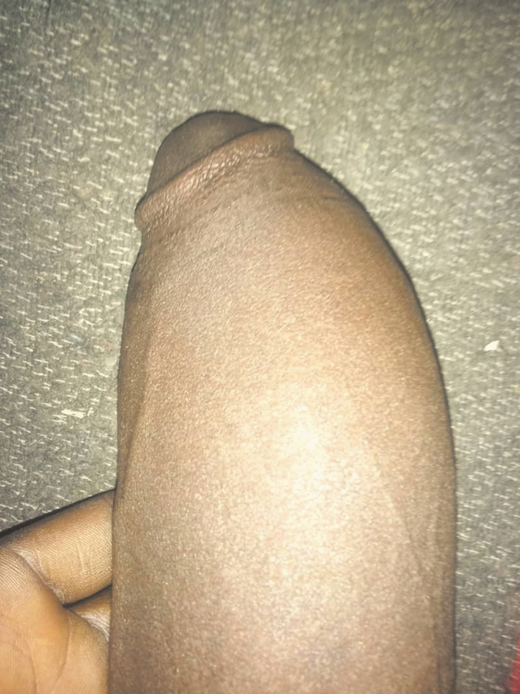 Edematous priapic penis, an episode that lasted for 8 days in a young adult with SCD.