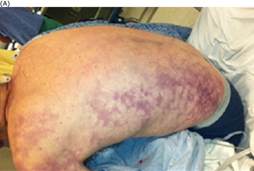 (A) Retiform purpura, (B) bullous skin necrosis, (C) peripheral dusking, and (D) microvascular thrombosis in purpura fulminans. Adapted from Colling and Bendapudi1 (A, C, and D) and from Davis MDP et al.43
