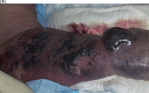 (A) Retiform purpura, (B) bullous skin necrosis, (C) peripheral dusking, and (D) microvascular thrombosis in purpura fulminans. Adapted from Colling and Bendapudi1 (A, C, and D) and from Davis MDP et al.43