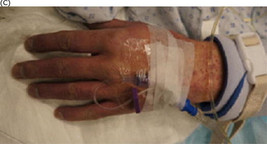(A) Retiform purpura, (B) bullous skin necrosis, (C) peripheral dusking, and (D) microvascular thrombosis in purpura fulminans. Adapted from Colling and Bendapudi1 (A, C, and D) and from Davis MDP et al.43