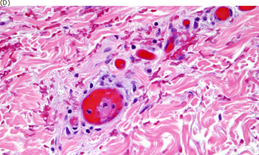 (A) Retiform purpura, (B) bullous skin necrosis, (C) peripheral dusking, and (D) microvascular thrombosis in purpura fulminans. Adapted from Colling and Bendapudi1 (A, C, and D) and from Davis MDP et al.43