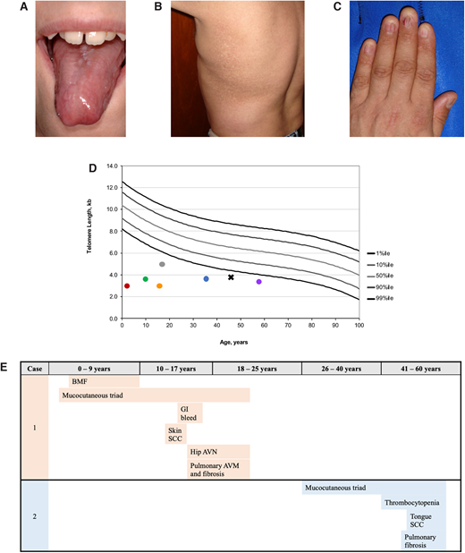 Examples of clinical manifestations of telomere biology disorders. (A) Tongue leukoplakia in Clinical Case 1; (B) hyper- and hypopigmentation on the trunk in Clinical Case 2; (C) nail dysplasia in Clinical Case 2; (D) examples of lymphocyte telomere lengths measured by flow cytometry with in situ hybridization from NCT00027274 study participants. Circle color codes by sex and causative gene: red, male with heterozygous TINF2; green, male with DKC1; gray, male with DKC1; orange, female with autosomal recessive RTEL1; blue, male with heterozygous TERT; purple, female with heterozygous TERC. Clinical Case 2 is designated with a black X; (E) TBD phenotype progression in Clinical Cases 1 and 2 by age group with age at diagnosis noted.