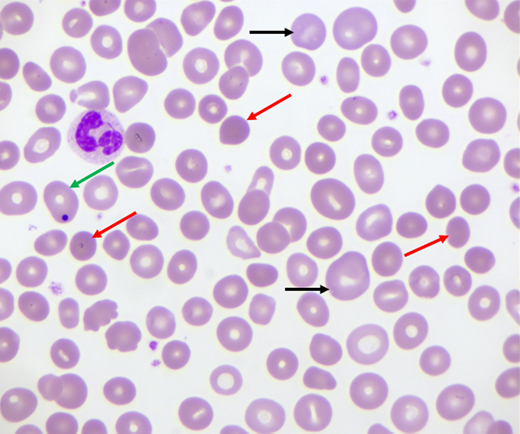 Peripheral blood smear in patient with wAIHA failing splenectomy. Increased numbers of spherocytes (red arrows) and polychromatophilic reticulocytes (black arrows), as well as one RBC with a Howell-Jolly body (green arrow), are indicated.