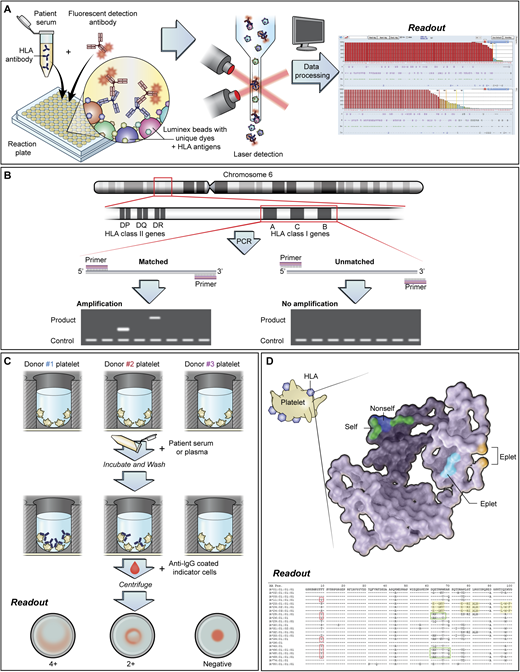 Testing methods for platelet refractoriness due to HLA alloimmunization. (A) Solid-phase assays are increasingly used to test for anti-HLA, anti-HPA, and anticomplement antibodies. In testing for HLA antibodies, beads are coated with 1 or more HLA antigens. Patient serum is added to the beads, followed by fluorescently labeled anti–human globulin to detect bound anti-HLA antibodies. Each bead is impregnated with a different ratio of dye, which produces a unique fluorescent signature that can be identified by Luminex technology. The mean fluorescence intensity (MFI) of the antibody-bound beads is used to determine positivity. Antibody screening platforms use beads coated with more than 1 antigen, while antibody specificity testing involves the use of single antigen beads. Other techniques for HLA antibody testing include flow cytometry and enzyme-linked immunosorbent assay–based methods. Caveats to solid-phase testing include the lack of a standardized MFI cutoff for determining antibody positivity. Low-level “positive” alloantibodies may not be clinically associated with transfusion refractoriness. Despite efforts to couple solid-phase assays with functional testing, newer methods that detect C1q-binding anti-HLA antibodies have not consistently demonstrated utility in platelet refractoriness. Additionally, assays may vary in their ability to detect anti-HPA alloantibodies. (B) HLA antigens are encoded on the short arm of chromosome 6. Among the HLA class I antigens, HLA-A and HLA-B are primarily implicated in alloimmune platelet transfusion refractoriness. Low-resolution HLA typing is generally performed for platelet transfusions, although high-resolution typing is required for epitope matching. (C) Platelet crossmatching identifies donor platelets that are not reactive to patient plasma. Crossmatching may be performed using various methods, including the solid-phase red cell adherence assay (which is shown), wherein wells are coated with donor platelets available in inventory. The platelet-coated wells are then incubated with patient plasma or serum, washed, reacted with anti-IgG coated indicator red cells, centrifuged, and read visually. Compatible donor products are selected for transfusion. (D) HLA class I antigens comprise a light chain (β subunit) and a heavy chain (α subunit), which have a standard crystalline structure with regions of polymorphic amino acid sequences, termed epitopes, that are immunogenic and serve as the basis of alloimmunization. Short groups of these polymorphic amino acids on the molecular surface form eplets, which may be linear sequences or discontinuous residues that lie in close proximity in the native, 3-dimensional conformation of the antigen. Eplets may be shared across many HLA subtypes. Epitope matching uses the nonself-self paradigm, in which alloantibodies are hypothesized to be directed against unfamiliar “nonself” eplets rather than “self” eplets. Therefore, in cases where there are mismatched patient-donor HLA antigens, the degree of eplet mismatch (ie, the number of “nonself” eplets present in the donor HLA antigens) may be calculated using computer algorithms to predict the likelihood of compatibility. PCR, polymerase chain reaction.