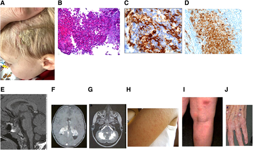Clinical, pathological, and radiographic features of LCH with cutaneous toxicities of MAPK inhibitors. (A) Scaly scalp rash in a 2-year-old boy. (B) LCH with a rich inflammatory background including osteoclast-like giant cells, eosinophils, and neutrophils (hematoxylin and eosin). (C) Immunostain showing surface CD1a expression. (D) Mutant-specific BRAF-VE1 immunostain with dark granular cytoplasmic staining in the lesional histiocytes (immunostain 400 × ). (E) Granulomatous CNS-LCH: brain MRI sagittal T1W image lacking posterior pituitary bright spot. (F) Brain MRI in a patient with granulomatous CNS-LCH: axial contrast-enhanced T1W image showing extensive bilateral lesions in the choroid plexus. (G) ND-LCH: axial T2-weighted image showing extensive dentate nucleus and white matter cerebellar neurodegeneration. (H) Skin hyperkeratosis pilaris of the left arm in a patient treated with a BRAF inhibitor. (I) Lobular panniculitis of the right leg in a patient on a MEK inhibitor. (J) Cutaneous squamous cell carcinoma in a adult treated with a BRAF inhibitor.