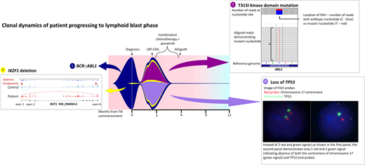 Fish plot illustrating mutation profile and clonal dynamics of patient 1. This patient progressed to lymphoid blast crisis within 3 months of diagnosis. This figure illustrates the complex clonal dynamics involved, with the fish plot highlighting the primary BCR::ABL1 clone in addition to the 3 subclones, including expansion of the IKZF1 subclone detectable at diagnosis in addition to the acquisition of T315I as well as loss of TP53. Detection of all variants involved NGS, Sanger sequencing, and cytogenetic analysis. The IKZF1 deletion is indicated by aberrant splicing, with the breakpoints indicated by the red arrows. The T315I mutation is shown on NGS while the loss of TP53 is indicated via fluorescence in situ hybridization probes. Combination chemotherapy in addition to ponatinib enabled clearance of the leukemic clone; LBP, lymphoid blast phase.