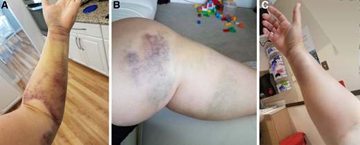 Bleeding in a case of postpartum-associated AHA. (A) Soft tissue bleeding in left arm; (B) soft tissue bleeding in left leg; (C) soft tissue bleeding resulting in compartment syndrome in right forearm.