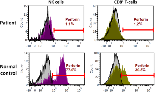 Perforin deficiency detected by flow cytometry. Histogram plots depicting flow cytometry analysis of peripheral blood lymphocytes from the patient described in case 1. Upper panels depict patient cells, while the lower panels depict normal controls. Results for natural killer (NK) cells are shown on the left, while those for CD8+ T lymphocytes are shown on the right. Isotype controls are represented by the gray histograms, and perforin antibody detection is represented by the histograms in magenta (NK) or green (CD8+).