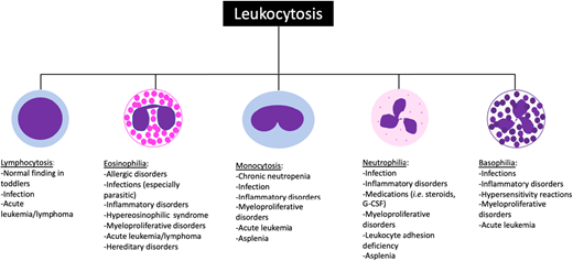 Common causes of leukocytosis in pediatric patients. The differential diagnosis can often be narrowed down based on which white blood cell subtype is elevated. G-CSF, granulocyte colony stimulating factor.