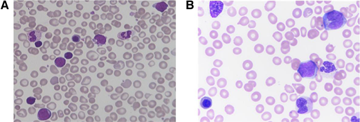 Peripheral blood findings in TAM and JMML. Peripheral blood smears of (A) TAM showing pleiomorphic blasts and additional immature myeloid cells, and (B) JMML showing leukoerythroblastosis with circulating myelomonocytic cells. Both smears show dysmorphic and nucleated red blood cells.