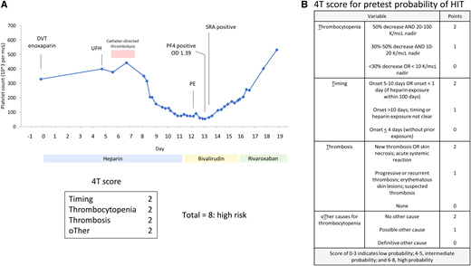 Clinical case 1: heparin induced thrombocytopenia (HIT). (A) Time course for platelet count (blue) with heparin exposure demonstrates characteristic pattern of HIT. The platelet factor 4 (PF4) immunoassay was strongly positive (OD  =  1.39; cutoff for positivity OD ≥0.4), and the serotonin release assay (SRA) was positive. Platelet count recovered after discontinuation of heparin and transition to a direct thrombin inhibitor, bivalirudin, and then rivaroxaban. (B) 4T score for pretest probability of HIT. The patient scored a high probability of HIT with a score of 8. DVT, deep vein thrombos; OD, optical density; PE, pulmonary embolism; UFH, unfractionated heparin.