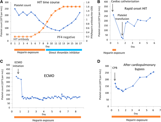 Patterns of thrombocytopenia for HIT and conditions confused for HIT. (A) Time course for drop in platelets (blue) in response to increase in HIT antibody titer (orange squares). Recovery of platelet count with discontinuation of heparin and transition to direct thrombin inhibitor. (B) Rapid onset HIT. Patient was previously treated with heparin and developed rapid onset of thrombocytopenia with heparin exposure. (C) Thrombocytopenia with extracorporeal membrane oxygenation (ECMO)—not HIT. Rapid and sustained thrombocytopenia is seen with initiation of ECMO due to platelet consumption within the circuit. (D) Thrombocytopenia after cardiopulmonary bypass (CPB)—not HIT. Platelet drop within 1-3 days after CPB, followed by recovery.