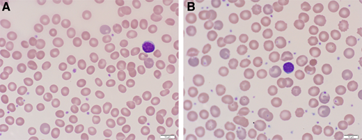 Peripheral blood film from a patient with PK deficiency with an intact spleen (A) and after splenectomy (B). The red cell findings in PK deficiency with an intact spleen are mild. Nonspecific or bland red cell morphology in a patient with a congenital hemolytic anemia should raise suspicion for an enzymopathy. After splenectomy, the peripheral blood film is notable for moderate polychromasia and echinocytes.
