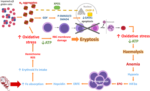 Mechanism of oxidative stress, ineffective erythropoiesis and hemolysis in β-thalassemia. Impaired α- to β-globin ratio results in aggregation and precipitation of the excess α-globin, exerting oxidative stress on the developing RBC. Concurrently, α-globin aggregates induce the sequestration of HSP70 in the cytoplasm, GDF activation and phosphorylation of SMAD2/3, and activation of SMAD4. Both processes lead to reduced GATA1 resulting in eryptosis. RBCs that exit the marrow soon undergo hemolysis because of shortened RBC lifespan. Modified from Longo F, Piolatto A, Ferrero GB, Piga A. Int. J. Mol. Sci. 2021, 22, 7229, Taher A and Saliba AN. Hematology Am Soc Hematol Educ Program. 2017 Dec 8;2017(1):265-271; Musallam KM, et al. Haematologica. 2011;96(11):1605-1612; Rivella S. Haematologica. 2015;100(4):418. ATP, adenosine triphosphate; EPO, erythropoietin; ERFE, erythroferrone; GDF, growth differentiation factor; HIF2α, hypoxic inducible factor 2α; HSP70, Heat Shock Protein 70; RBC, red blood cell; ROS, reactive oxygen species; XPO-1, exportin-1.