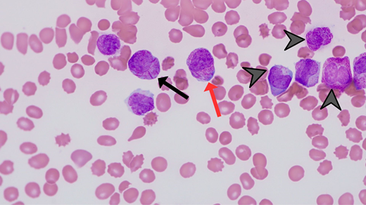 Photomicrograph (magnification 60 × ) depicting morphologic features of APL, including abundant primary azurophilic granules (red arrow), multiple Auer rods (black arrow), and reniform or bilobed nuclear contours (arrowheads).