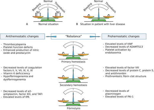 Schematic presentation of the rebalanced hemostatic system in patients with liver disease. In healthy individuals (A), the hemostatic system is in solid balance. In patients with liver disease (B and table) both prohemostatic and antihemostatic changes result in a “rebalance” of the hemostatic system. This new balance is characterized by specific hypocoagulable and hypercoagulable features. ADAMTS13, a disintegrin and metalloproteinase with a thrombospondin type 1 motif, member 13; PAI-1, plasminogen activator inhibitor-1; TAFI, thrombin activatable fibrinolysis inhibitor; tPA, tissue plasminogen activator; VWF, von Willebrand factor. Reprinted from van den Boom & Lisman with permission.46