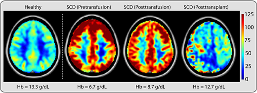Changes in cerebral blood flow before and after blood transfusions and haplo-BMT with thiotepa and PTCy in a patient with SCD. Quantitative cerebral blood flow (CBF) maps show that CBF increases to maintain sufficient oxygen and glucose supply in people with anemia. The healthy image depicts the brain of an African American woman (aged 32 years, HbAA) with a hemoglobin concentration of 12.6 g/dL and a cortical CBF (assessed by arterial spin labeling magnetic resonance imaging) of 40 to 60 mL per 100 g per min. The SCD images are from an African American man with SCD (aged 34 years, hemoglobin SS); pretransfusion, his CBF was elevated to offset reduced oxygen content. Following blood transfusion, which increased the total hemoglobin and reduced the proportion of hemoglobin S, the CBF decreased but remained elevated relative to that in nonanemic individuals. After haploidentical BMT (haplo-BMT) with thiotepa and PTCy, both anemia and HbS were eliminated, and CBF approached that of a healthy control (HbAA). CBF heterogeneity was still present in this patient due to underlying moyamoya vasculopathy. Hb, hemoglobin concentration. (From Lancet Neurol. 2021 May;20(5):398-408.)