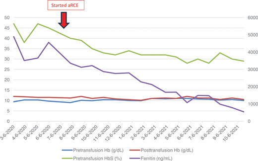 Laboratory values of patient reported in clinical case before and after aRCE. Pretransfusion and posttransfusion hemoglobin (Hb) and hemoglobin S (HbS) are shown on the left axis with units g/dL and percent, respectively. Units for ferritin shown on right axis with units ng/mL. A double lumen port was placed in July 2020, and patient started aRCE in August 2020 using 6 U for each aRCE. Note prior to this, posttransfusion hemoglobin shown in red was typically 11-12 g/dL. Over the next year on aRCE, his posthemoglobin level was closer to his pretransfusion hemoglobin level, typically 10 g/dL. On aRCE, his pretransfusion HbS level decreased and was ultimately maintained closer to his target 30%. His ferritin steadily declined, and he was able to stop chelation medication within 9 months.