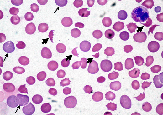 Peripheral blood film showing classic findings of TMA. The image shows features of thrombocytopenia and microangiopathic hemolysis with an increase in schistocytes (bold arrows). Reticulocytes (narrow arrows) are also increased and indicate increased red cell turnover.