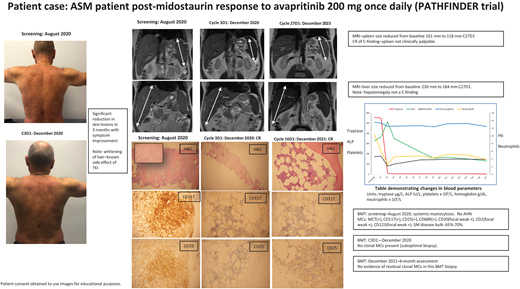Clinical case summary of ASM patient's response to second-line TKI treatment. In patients with pure MCL and ASM, treatment with midostaurin can result in a PR as our case illustrates. This patient had a diagnosis of c-KIT–positive ASM with AMN nor any additional myeloid mutations. He was initially treated with midostaurin 100 mg twice a day. His symptoms and MC disease burden improved, as reflected by reduced spleen size, improvement of skin rash, and decreased tryptase levels. After 18 months his symptoms recurred, including fatigue, sweats, worsening rash, and increased splenomegaly and tryptase levels. He had lost his response to midostaurin. He subsequently was enrolled in the PATHFINDER trial and received avapritinib 200 mg once daily initially. As seen in Figure 1, he had an excellent response, achieving a CR within 3 months of treatment, which has been maintained. He experienced the expected side effects of mild periorbital edema, whitening of his hair, and an “ALP flare,” which is seen with initiation of TKI treatment and normalizes in 4 to 6 weeks. As reported in PATHFINDER, patients with pure ASM achieve a deep, fast response despite previous exposure to another TKI—midostaurin, in his case. Should he have an allogenic bone marrow transplant? The current view is that because he has no AMN and only harbors the c-KIT mutation, he should continue on a reduced dose of avapritinib 100 mg once daily. It will be interesting to see if this dose could be reduced or interrupted to see if he maintains a CR in the future. BMT, bone marrow trephine; H&E, hematoxylin and eosin stain; MRI, magnetic resonance imaging.