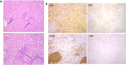 Illustrative lymph node histopathology in ALPS-FAS. (A) Paracortical expansion, which is typical for ALPS. Arrows point to reactive follicles. Lower panel showing higher-power view of the cellular composition of the paracortex, bottom arrow showing reactive follicle. (B) Immunohistochemistry showing CD3, CD4, and CD8 stain to highlight presence of double-negative T cells in the paracortical expansion. Bottom left panel shows reactive B-cell follicle (CD20).