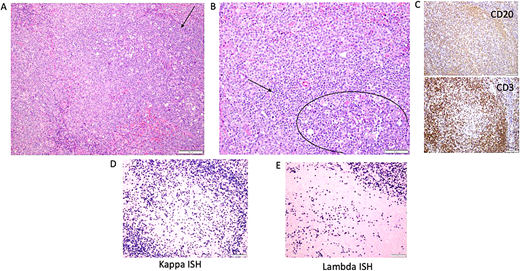Illustrative lymph node histopathology in APDS1. (A) Arrow is pointing toward the germinal centers identified by the presence of larger cells and numerous tangible body macrophages. (B) Circle defines the germinal centers with a rim of small lymphocytes with condensed chromatin (T cells). (C) CD3 and CD20 images showing out circle of monocytoid B cells (CD20). (D–E) Another feature that is often seen as marked plasmacytosis, like in this case with kappa greater than lambda (in tissue the ratio can be up to 4:1). ISH, in situ hybridization.
