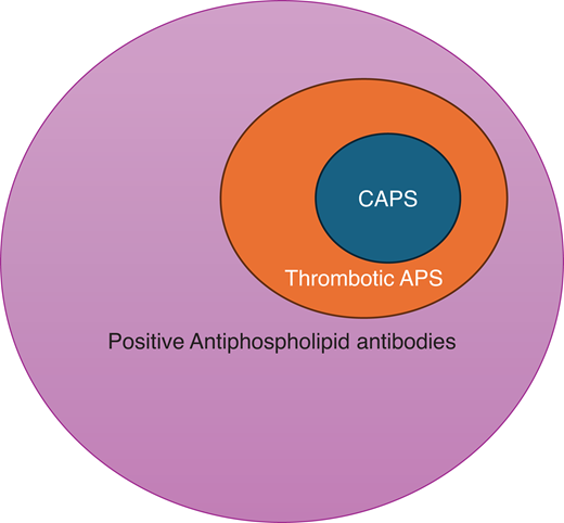 The overlap of CAPS and thrombotic antiphospholipid syndrome. The presence of aPLs and complement gene abnormality fosters a procoagulant and proinflammatory environment, which increases the risk for macrovascular (venous and arterial) thrombotic events in APS. Approximately 1% of patients with APS develop a severe picture of catastrophic APS (CAPS). The “2-hit” theory suggests that the presence of additional precipitating factors (including infection, inflammation, pregnancy, surgery, trauma, etc) leads to a domino effect that results in activation of the complement system, endothelium, and coagulation cascade, as well as immune cell activation, which are key contributors to the pathogenesis of CAPS.