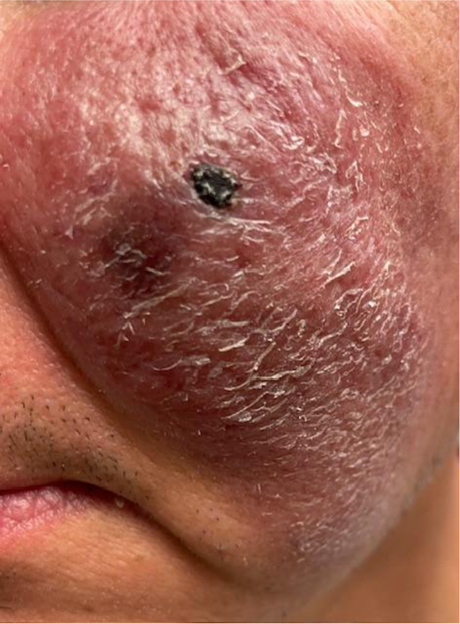 Typical BPDCN lesion of a sun-exposed area. A 67-year-old man presented with a persistent facial/check lesion, characterized as a violaceous maculopapular skin abnormality with a central necrotic area. Originally suspected to be likely melanoma by visual exam, which would have been a much more common entity appropriately fitting the setting, the abnormality instead confirmed a diagnosis of BPDCN through biopsy.
