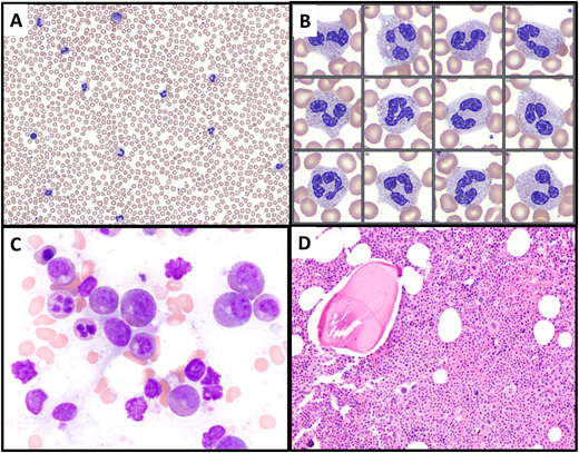 Illustration of Case 1. (A, B) A peripheral blood smear, showing leukocytosis with neutrophil predominance and only a rare myelocyte (upper center of image A). Neutrophils exhibit normal morphology. (C) The bone marrow aspirate smear shows predominance of granulocytic forms, without significant dysplasia. (D) The bone marrow biopsy is markedly hypercellular with an elevated myeloid to erythroid ratio and intact granulocytic maturation. Megakaryocytes are not increased, do not cluster, and include some small forms.