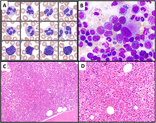 Illustration of Case 2. (A) A peripheral blood smear (neutrophil and basophil images), showing normal-appearing neutrophils and mild basophilia. (B) Bone marrow aspirate smear shows increased eosinophils (13%) and small hypolobated megakaryocytes. (C, D) Bone marrow biopsy is markedly hypercellular, with a slightly increased myeloid to erythroid ratio and many small hypolobated megakaryocytes.